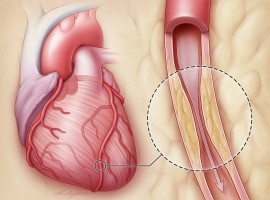 Особенности ишемической болезни сердца в пожилом возрасте фото